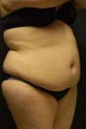 Abdominoplasty