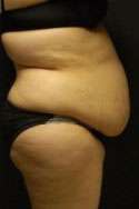 Abdominoplasty