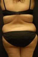 Abdominoplasty