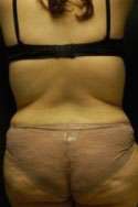 Abdominoplasty