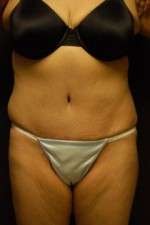 Abdominoplasty
