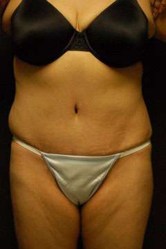 Abdominoplasty