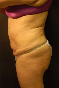 Abdominoplasty