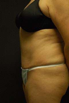 Abdominoplasty