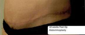 Abdominoplasty