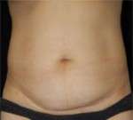 Abdominoplasty