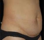 Abdominoplasty