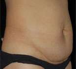 Abdominoplasty