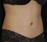 Abdominoplasty