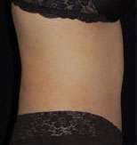 Abdominoplasty
