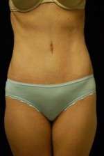 Abdominoplasty