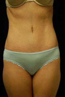 Abdominoplasty