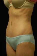 Abdominoplasty