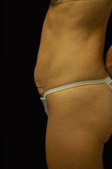 Abdominoplasty