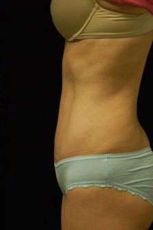 Abdominoplasty
