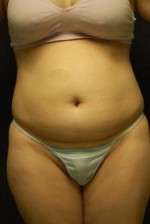 Abdominoplasty