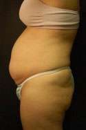 Abdominoplasty