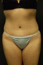 Abdominoplasty