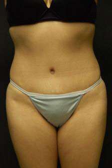 Abdominoplasty
