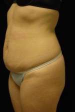 Abdominoplasty
