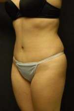 Abdominoplasty