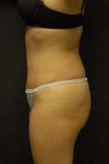 Abdominoplasty