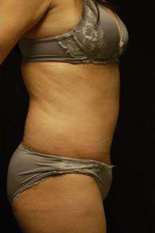 Abdominoplasty