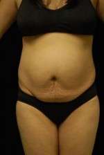 Abdominoplasty