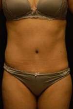 Abdominoplasty