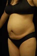 Abdominoplasty