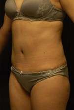 Abdominoplasty