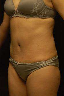 Abdominoplasty