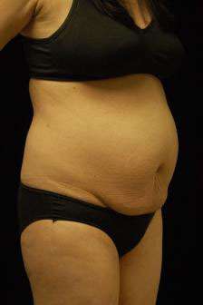 Abdominoplasty