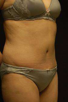 Abdominoplasty