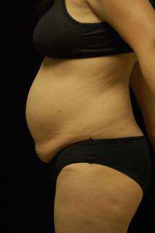 Abdominoplasty