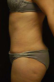 Abdominoplasty