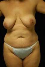 Abdominoplasty