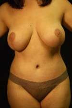 Abdominoplasty