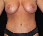 Abdominoplasty