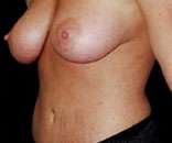 Abdominoplasty