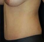 Abdominoplasty