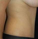 Abdominoplasty