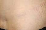 Abdominoplasty