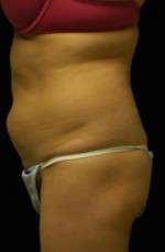 Abdominoplasty