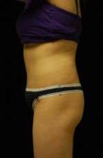 Abdominoplasty