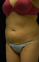 Abdominoplasty
