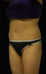 Abdominoplasty