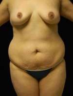 Abdominoplasty