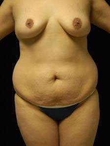 Abdominoplasty