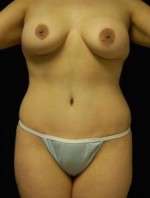 Abdominoplasty